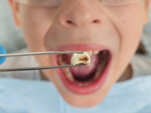 Best Emergency Treatment for Dental Infections or Abscesses in Granbury, TX