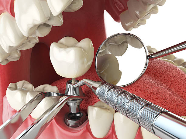 Best Emergency Gum Treatment in Granbury, TX